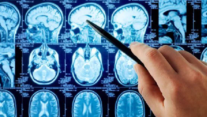 Bilim insanları açıkladı: Obeziteli bireylerin beyin şekli farklı